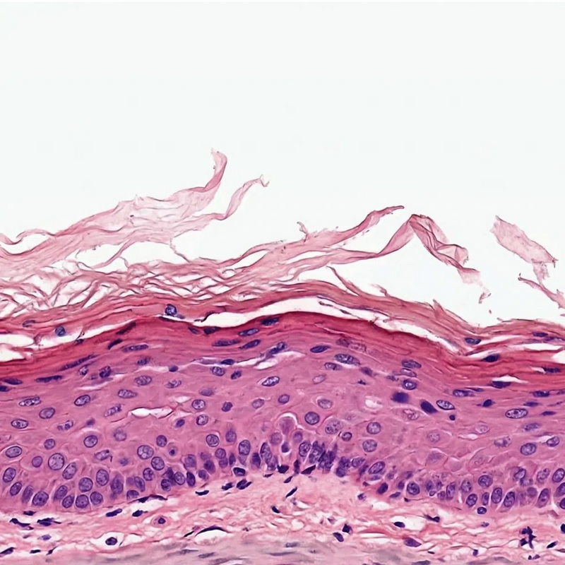 B: Photoaged, Wrinkled Female Facial Skin (H&E)