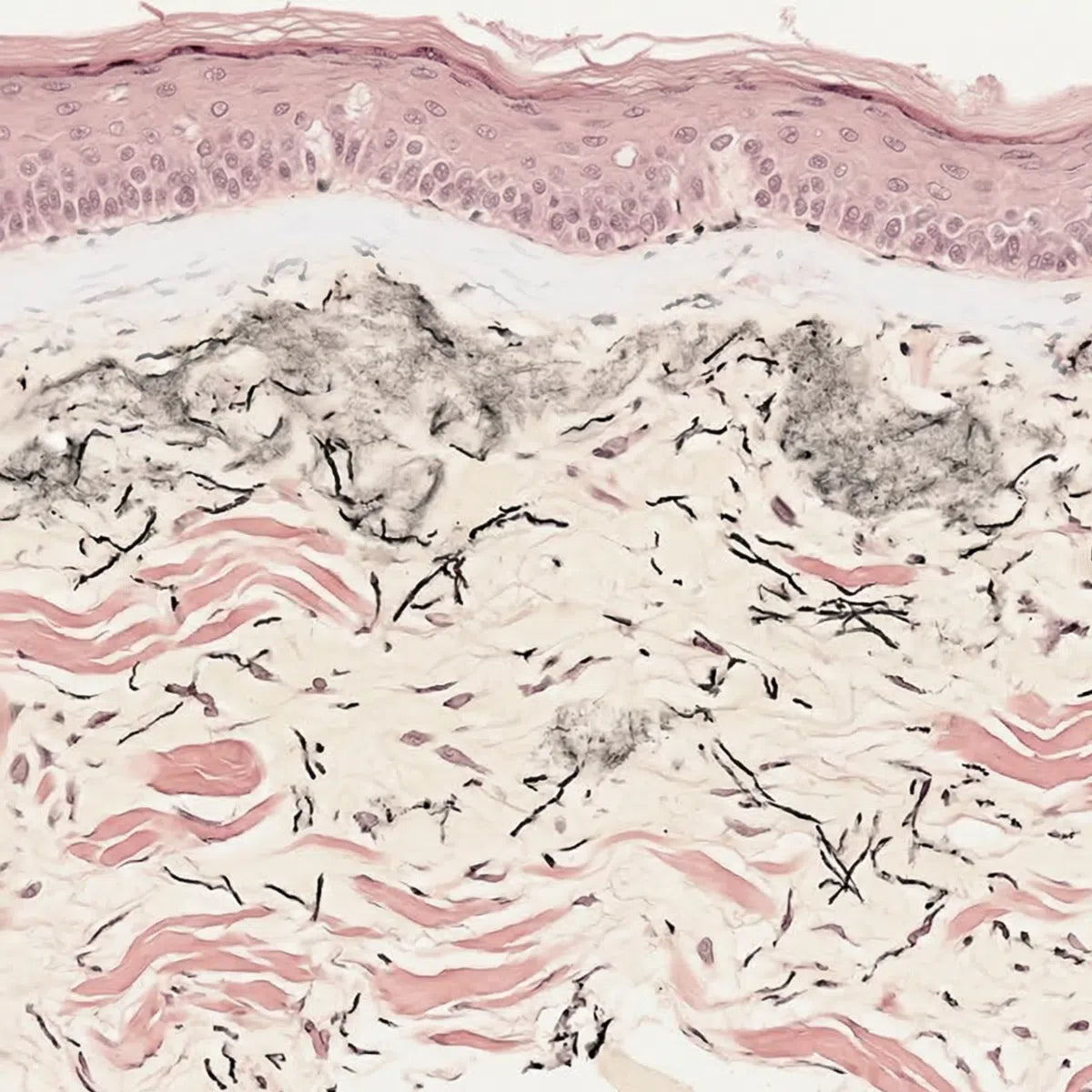 Verhoeff-Van Gieson staining showing solar elastosis with clumped elastic fibres and grenz zone